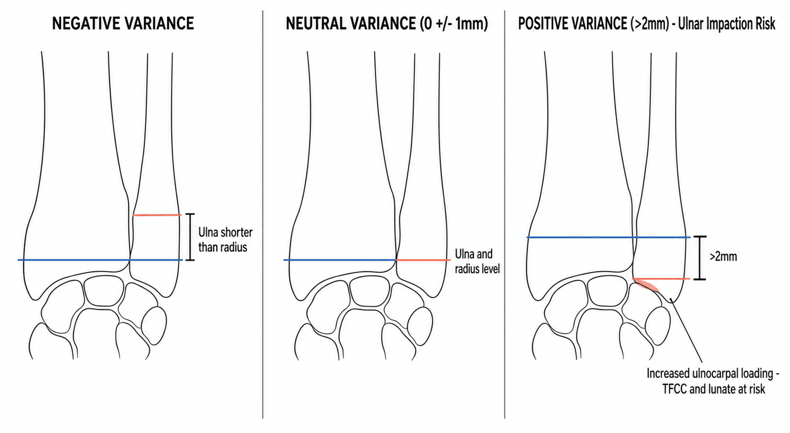Schematic diagram of PA wrist views comparing negative, neutral and positive ulnar variance measurement