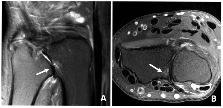 Two MRI panels, the second an axial slice, with arrows at the distal radioulnar joint in DRUJ arthrosis