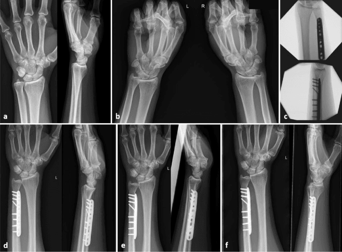 PA and lateral wrist radiographs, bilateral clenched-fist PA views, intraoperative fluoroscopy of a plated ulnar osteotomy and serial postoperative radiographs