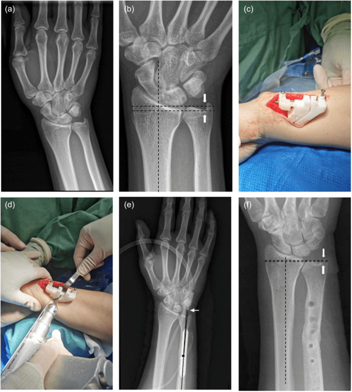 Three-dimensional guide-assisted ulnar shortening: variance reference lines, a cutting guide pinned to the ulna, the saw cut and later radiographs