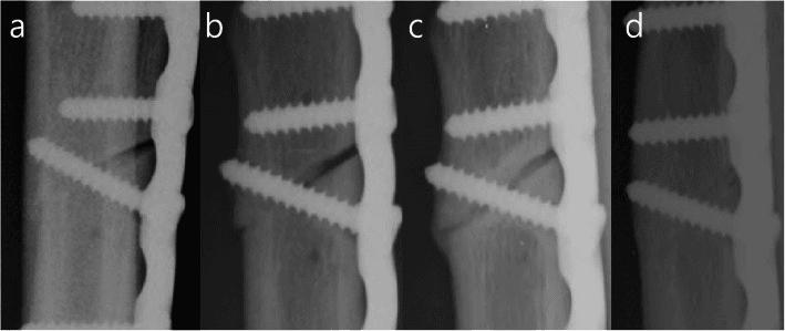 Serial close-up radiographs of a long oblique osteotomy gap beside a lag screw, slowly uniting