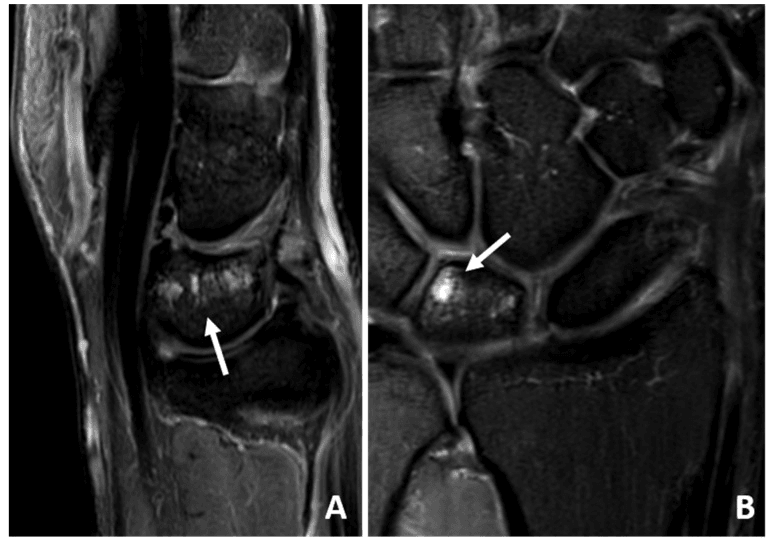 Two fluid-sensitive MRI panels with arrows at focal lunate marrow oedema