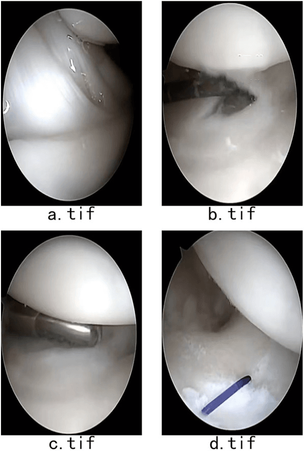 Four arthroscopic views (a-d) of a Palmer 2C triangular-disc lesion, with instruments at the disc and a probe on the treated surface