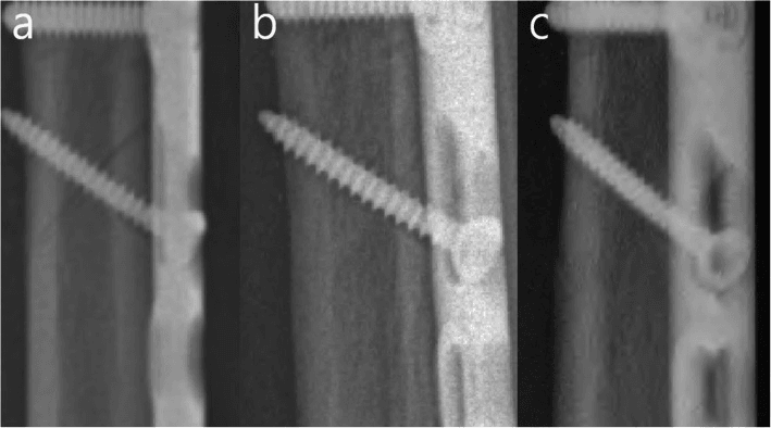 Serial close-up radiographs of a parallel-cut ulnar osteotomy uniting beside a lag screw