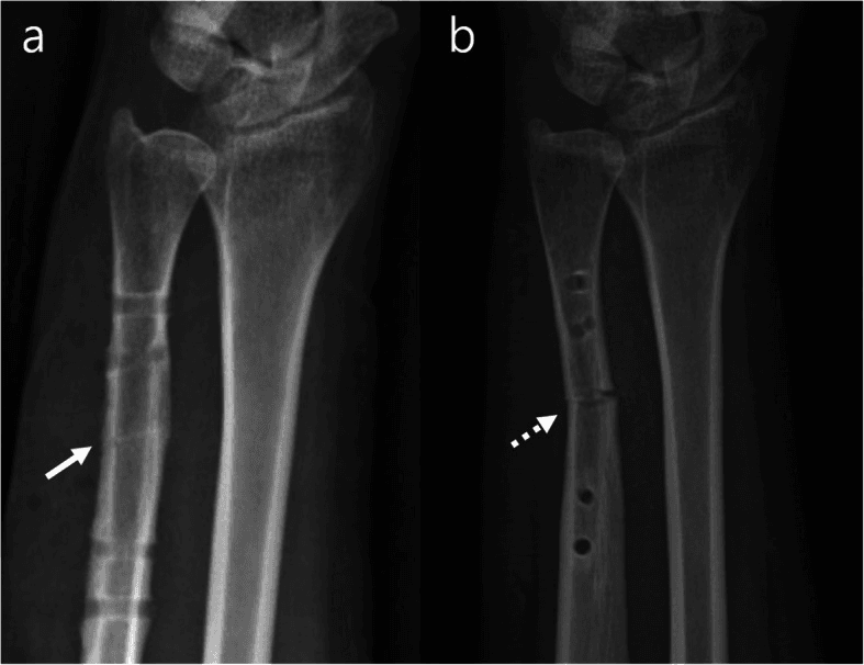 Radiographs after plate removal showing a residual osteotomy trace and a later refracture