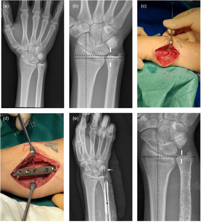 Standard ulnar shortening osteotomy: preoperative films with variance reference lines, operative exposure and plating, and later radiographs