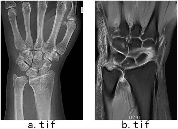 PA wrist radiograph without static positive ulnar variance, and MRI showing a central TFCC perforation