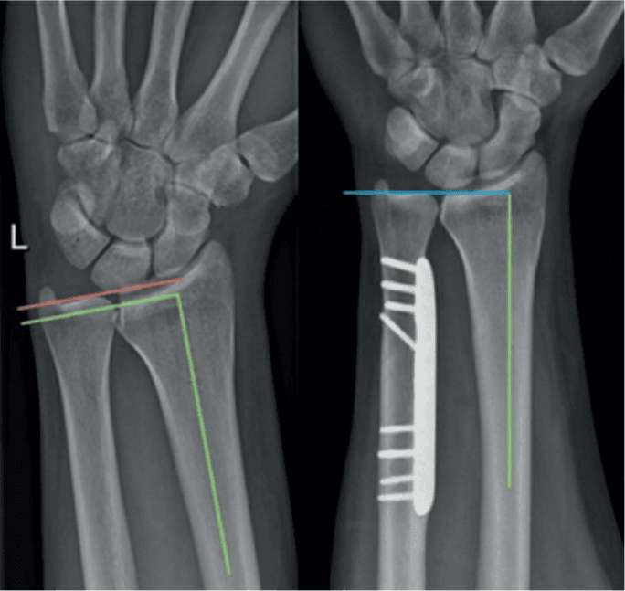 Wrist radiographs before and after ulnar shortening with ulnar variance reference lines drawn