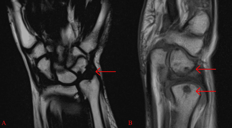 Two MRI panels of chronic ulnotriquetral impaction, with arrows marking the ulnocarpal abutment and focal lesions in two opposing bones