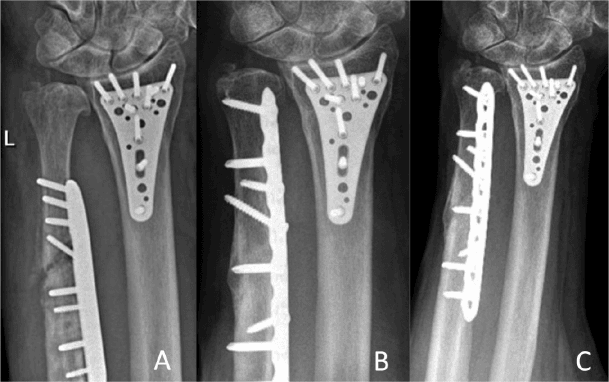 Loosened ulnar plate before osteotomy union and serial radiographs after revision fixation, with a distal radius plate also in place
