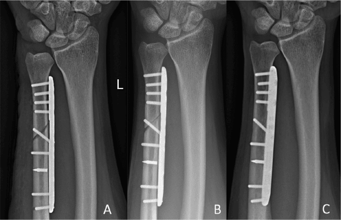 Serial radiographs (A-C) of an ununited plated oblique ulnar shortening osteotomy