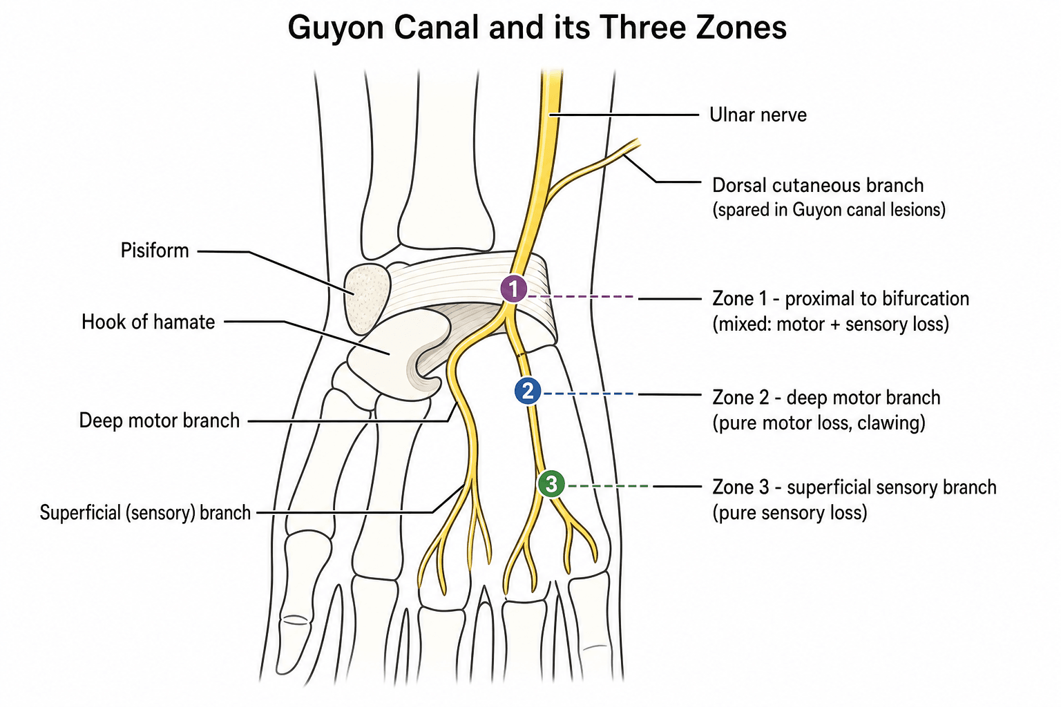 Diagram of Guyon's canal at the wrist showing the pisiform and hook of hamate, the nerve's division into superficial and deep branches, and the three zones.