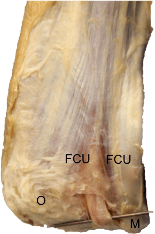 Cadaveric dissection of the medial elbow showing the ulnar nerve passing between the two heads of flexor carpi ulnaris