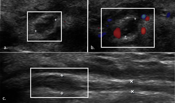 Grey-scale and colour Doppler ultrasound of a thickened hypervascular ulnar nerve in the cubital tunnel