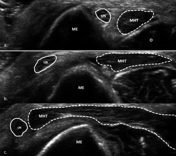 Dynamic transverse ultrasound showing ulnar nerve movement across the medial epicondyle during elbow flexion