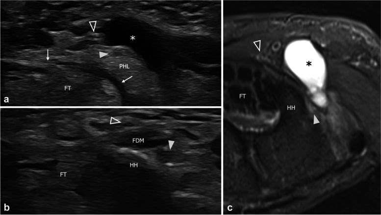 Ultrasound and MRI showing a ganglion compressing the deep motor branch of the ulnar nerve near the hook of hamate