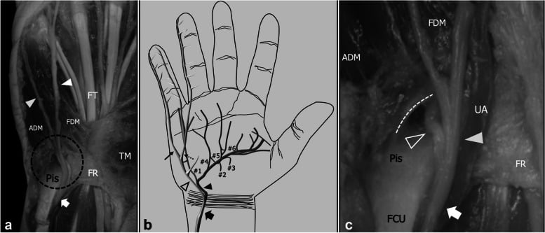 Cadaveric and schematic views of the ulnar nerve entering Guyon's canal beside the pisiform