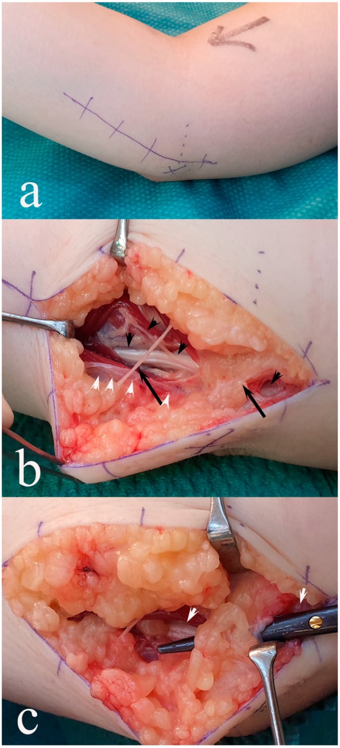 Three operative stages of open in situ cubital tunnel decompression