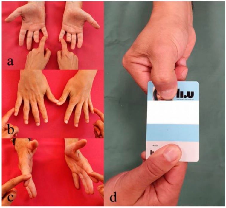 Clinical sequence testing ulnar-innervated FDP, abductor digiti minimi, first dorsal interosseous and adductor pollicis