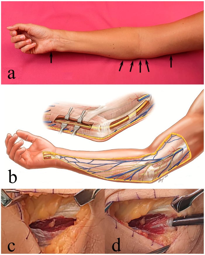 Composite showing the surface course and potential compression sites of the ulnar nerve from arm to wrist