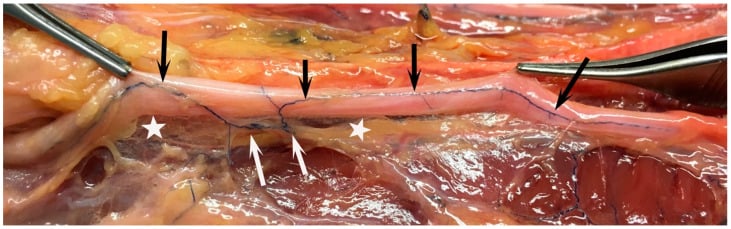 Cadaveric ulnar nerve showing its segmental extrinsic vascular supply
