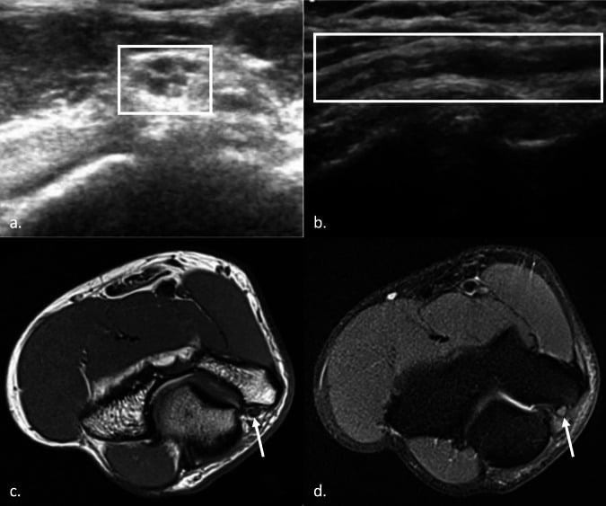 Ultrasound and MRI demonstrating an enlarged abnormal ulnar nerve at the cubital tunnel
