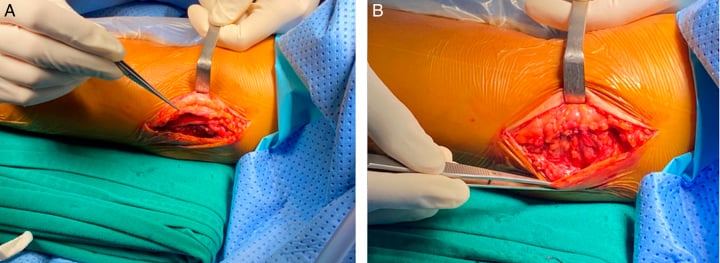 Two intraoperative photographs showing the ulnar nerve mobilised and secured anterior to the medial epicondyle