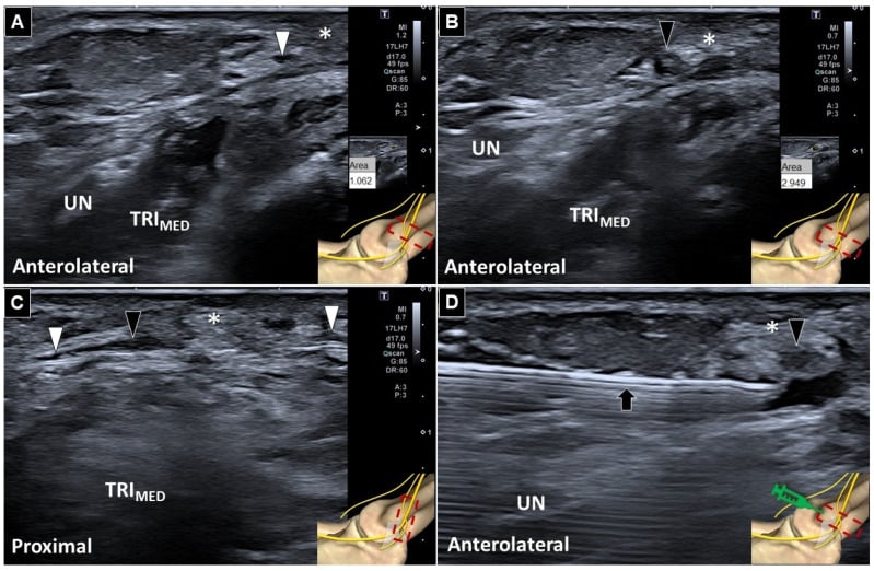 Comparative ultrasound showing a normal and enlarged injured posterior branch of the medial antebrachial cutaneous nerve adjacent to the ulnar nerve