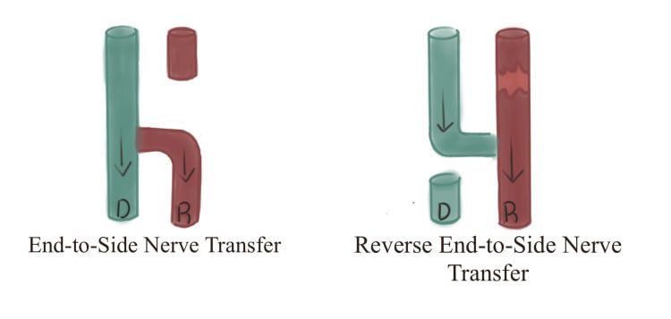 Schematic comparing end-to-side and reverse end-to-side nerve transfer configurations