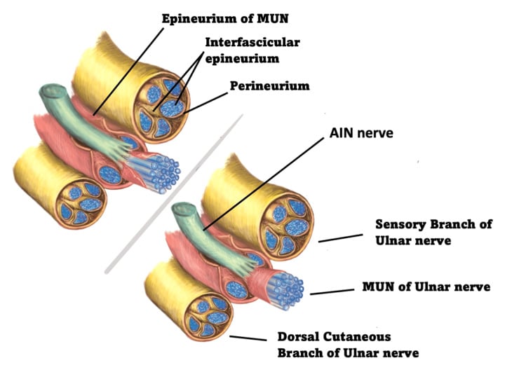 Illustration of distal forearm ulnar nerve fascicles and the anterior interosseous nerve donor for motor transfer