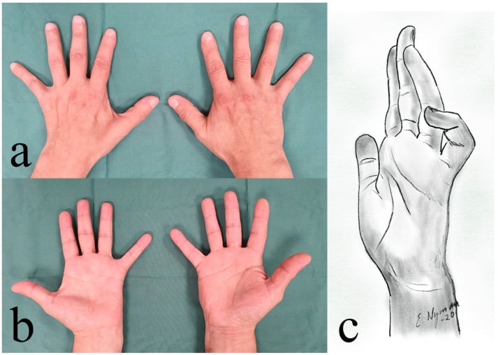 Four-panel clinical examination of severe ulnar palsy showing intrinsic wasting, abducted little finger, weak finger abduction and impaired key pinch