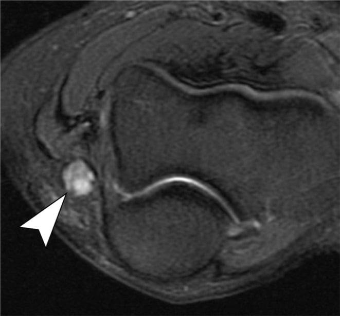 Axial fat-suppressed T2 MRI of the elbow showing an enlarged hyperintense ulnar nerve with loss of fascicular architecture