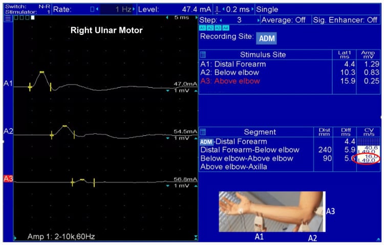Ulnar motor nerve conduction trace showing marked focal slowing across the elbow