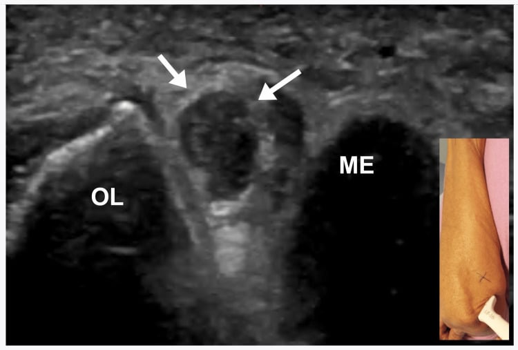 Short-axis ultrasound of the swollen ulnar nerve between the medial epicondyle and olecranon with cross-sectional area 16 square millimetres
