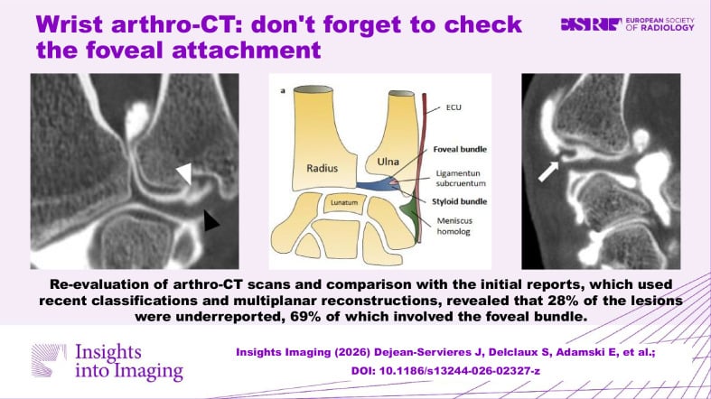Illustrated coronal anatomical diagram of the TFCC and DRUJ