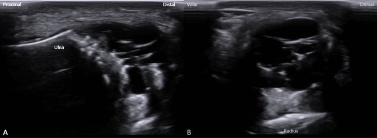 High-resolution sagittal ultrasound image of TFCC ganglion cyst