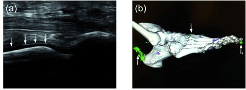 First metatarsophalangeal joint ultrasound showing the double-contour sign of gout, alongside a dual-energy CT reconstruction with urate deposits colour-coded.