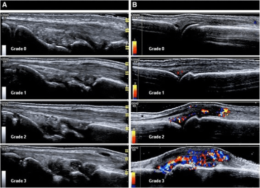 Paired greyscale and Doppler ultrasound across a four-grade semiquantitative scale (Grade 0 to 3) of increasing vascularity