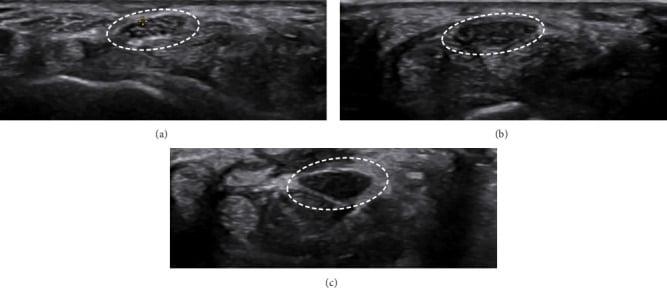 Transverse median nerve ultrasound in mild, moderate and severe carpal tunnel syndrome