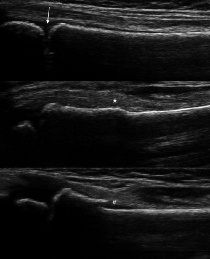 Paediatric distal radius ultrasound examples showing normal physis, buckle fracture and cortical breach