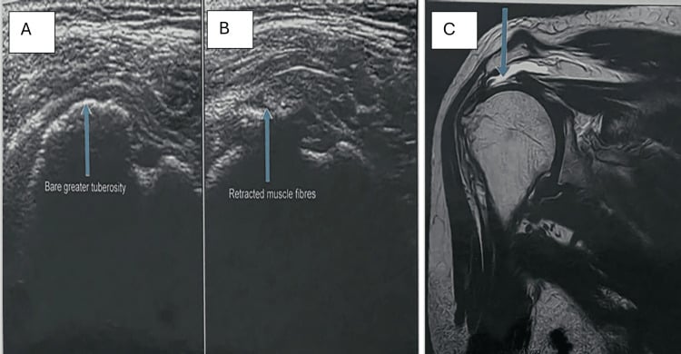 Ultrasound and coronal MRI of a full-thickness supraspinatus tear with tendon discontinuity and retraction