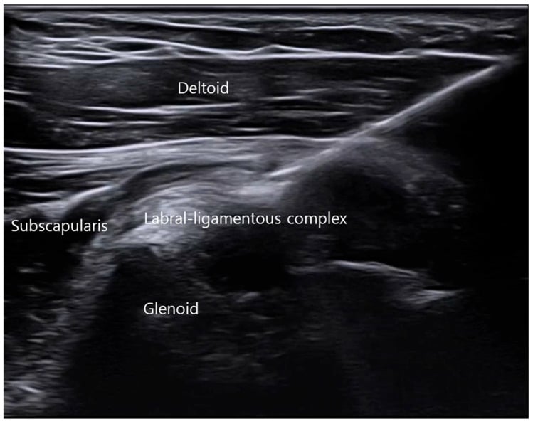 Ultrasound-guided in-plane needle trajectory to the anterior labral-ligamentous complex of the shoulder