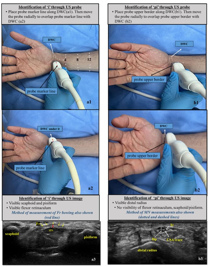Wrist and forearm landmarks with corresponding transverse median nerve ultrasound images and cross-sectional area measurements