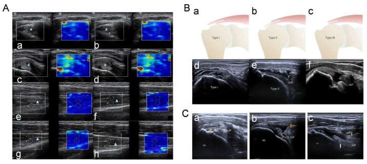 Shear-wave elastography sampling of the supraspinatus tendon and muscle in neutral and modified Crass positions