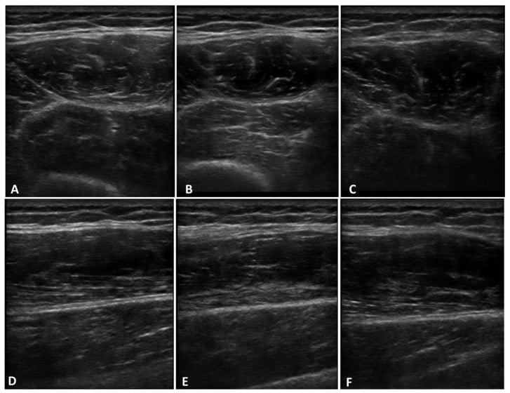 Real ultrasound images of deep fascia at three different probe angles, demonstrating the anisotropy artefact