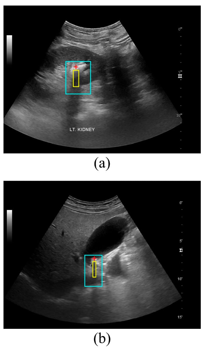 B-mode ultrasound scans demonstrating posterior acoustic shadowing artifact