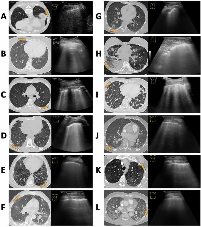 Ultrasound scan series illustrating B-lines, comet-tail, and reverberation artifacts