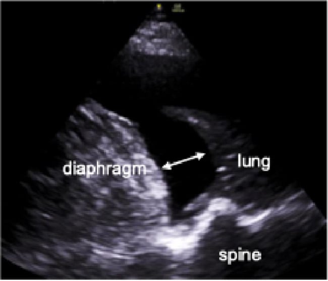 Ultrasound image demonstrating a diaphragm mirror-image artifact