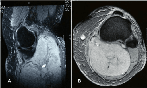 Two MRI panels of the leg showing a large heterogeneous deep soft-tissue mass with a rounded cystic component