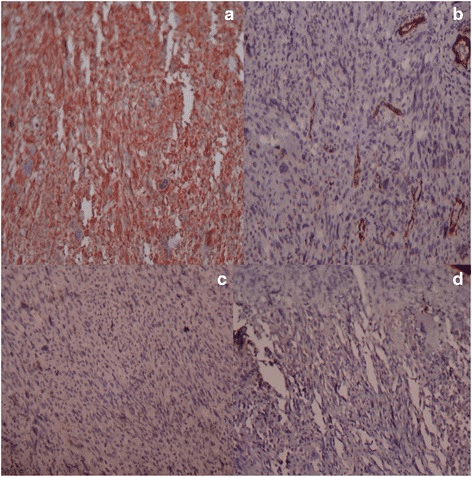 Undifferentiated Pleomorphic Sarcoma - vimentin immunohistochemistry staining showing strong cytoplasmic reactivity in tumor cells.